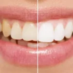 Hollywood Smile makeover in Dubai