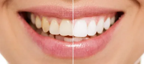 Hollywood Smile makeover in Dubai
