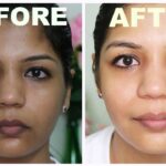 Does Glutathione Lighten Dark Spots
