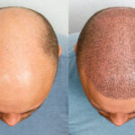 FUE Hair Transplant in Islamabad