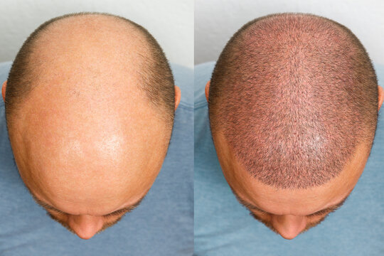 FUE Hair Transplant in Islamabad