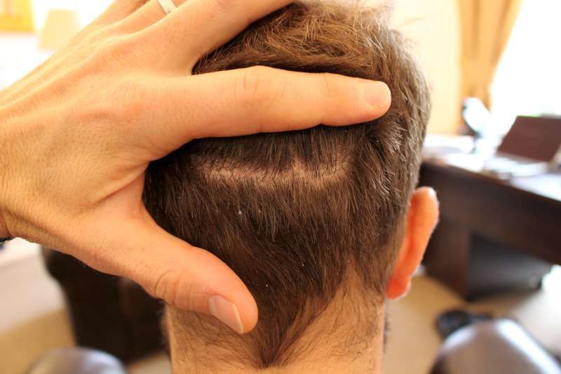 FUT Hair Transplant