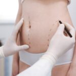 vaser liposuction in dubai