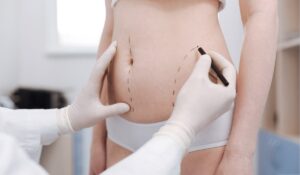 vaser liposuction in dubai