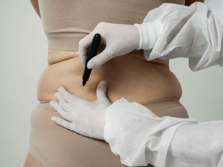 Liposuction in Dubai