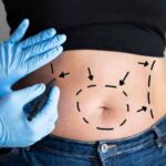 Liposuction in Islamabad