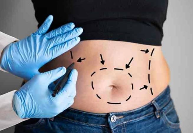 Liposuction in Islamabad
