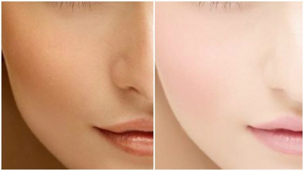 Skin Whitening for Oily Skin