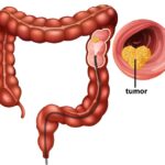 Treatment Options for Appendix Cancer Patients 