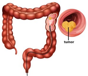 Treatment Options for Appendix Cancer Patients 