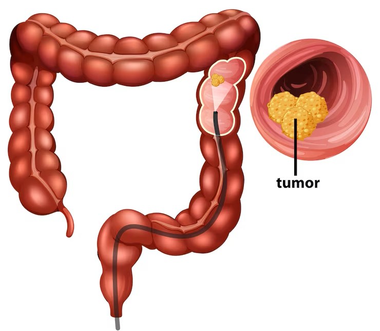 Treatment Options for Appendix Cancer Patients 