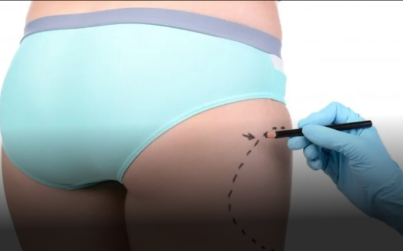 Buttocks Liposuction In Dubai