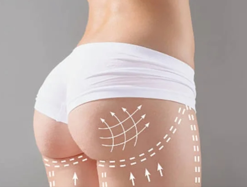 Laser Liposuction In Dubai