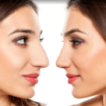 Rhinoplasty In Dubai