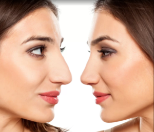 Rhinoplasty In Dubai