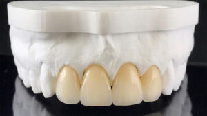 Zirconia Crown Dubai