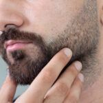 Beard Hair Transplant – Permanent Hair Restoration