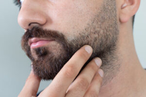 Beard Hair Transplant – Permanent Hair Restoration