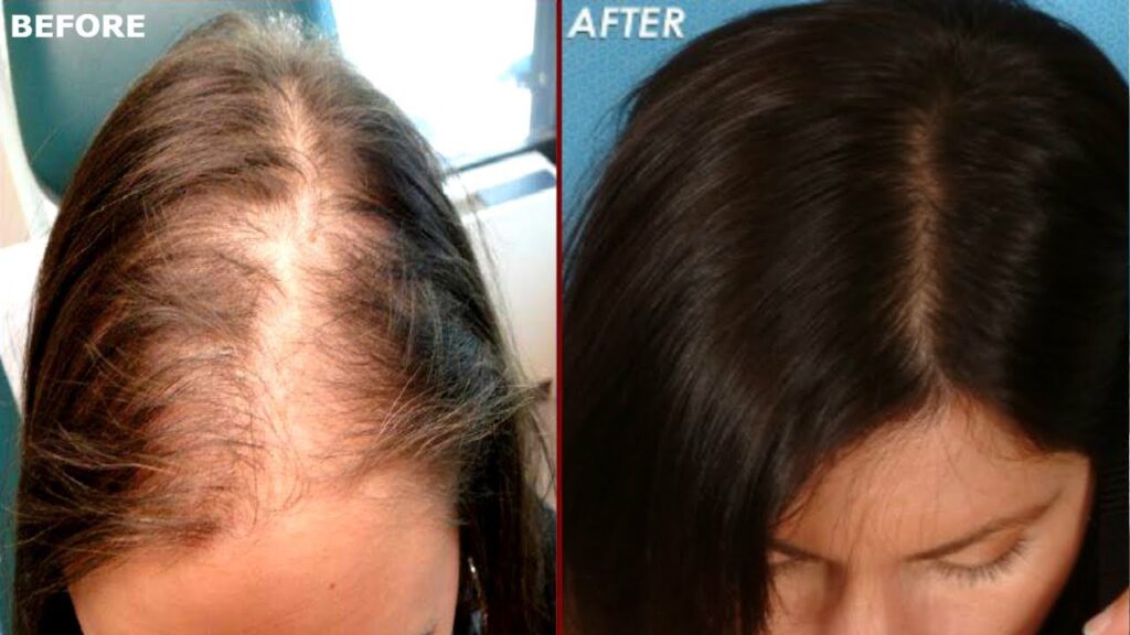 Best Hair Transplant in Islamabad