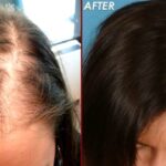Best Hair Transplant in Islamabad