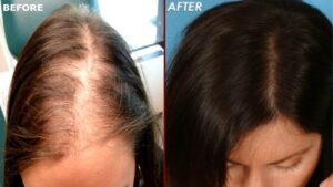 Best Hair Transplant in Islamabad