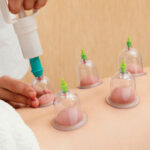 Cupping Therapy in Dubai