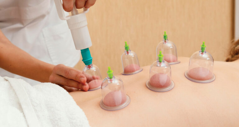 Cupping Therapy in Dubai