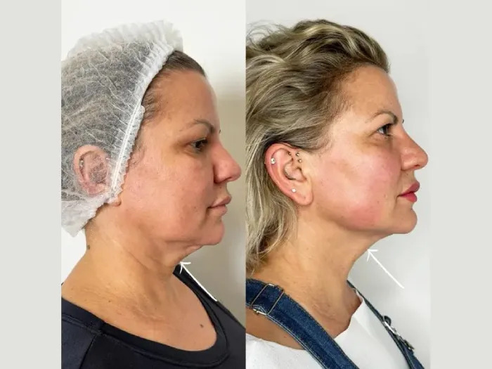 Endolift Treatments in Dubai for Cheek Lifting and Definition