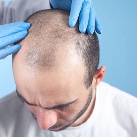 تكلفة زراعة الشعر في دبي