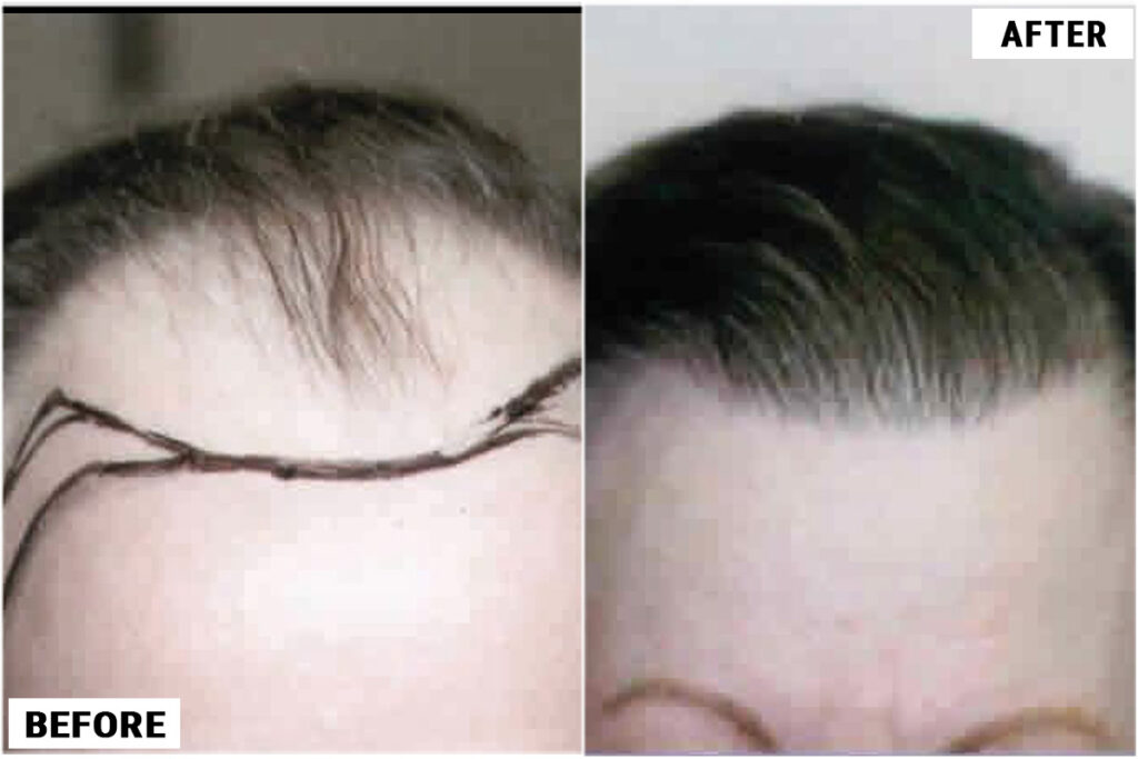 نتائج زراعة الشعر قبل وبعد