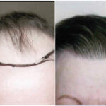 نتائج زراعة الشعر قبل وبعد