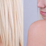 How Does Laser Wart Removal Work?