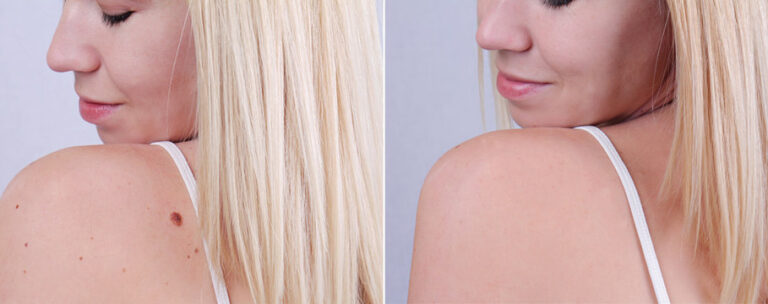 How Does Laser Wart Removal Work?