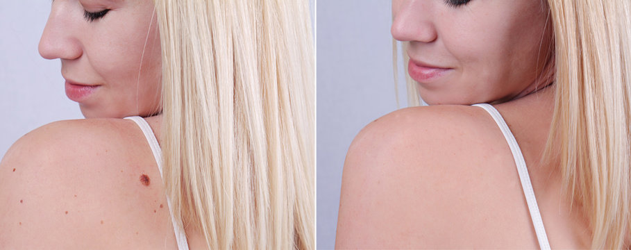 How Does Laser Wart Removal Work?