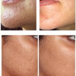 How to Remove Dead Skin After Microneedling