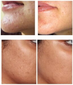 How to Remove Dead Skin After Microneedling