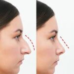 Rhinoplasty in Islamabad