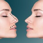 تجميل الأنف في دبي