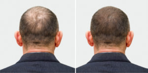 Hair Transplant