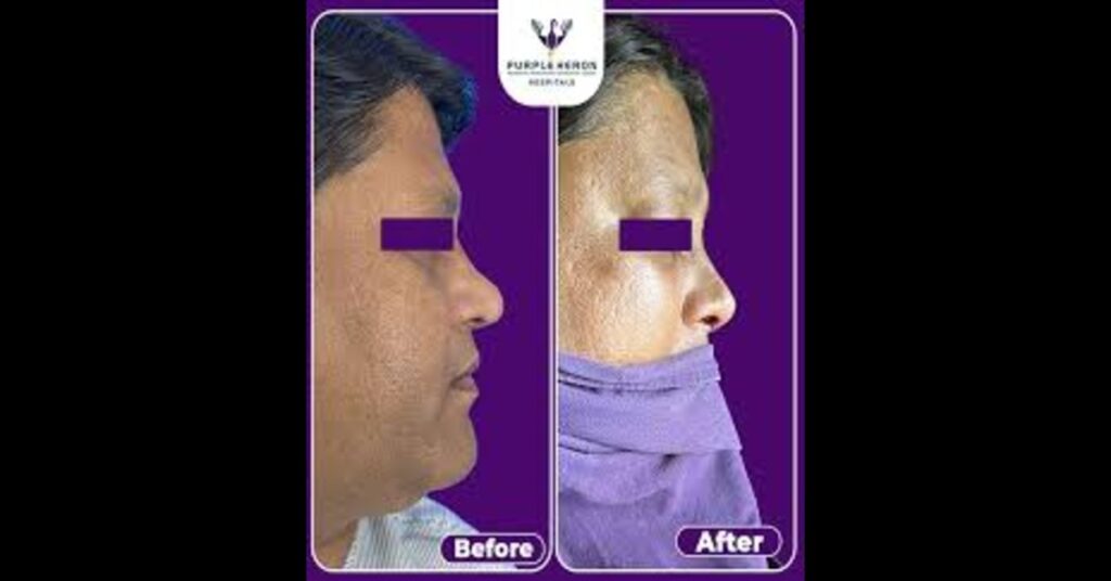 Rhinoplasty Surgery cost in Jaipur