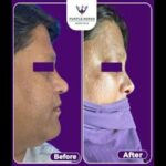 Rhinoplasty Surgery cost in Jaipur