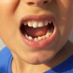 Real Patient Case Guide to Tooth Fracture Treatment in Islamabad