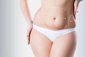 Best mini tummy tuck dubai