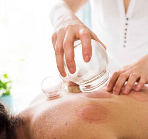 cupping1