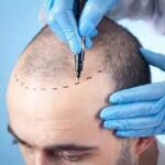 male hair transplant UK