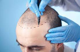 male hair transplant UK