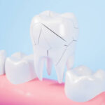 Immediate First Aid and Dental Care Guide Emergency Tooth Fracture Treatment in Pakistan: