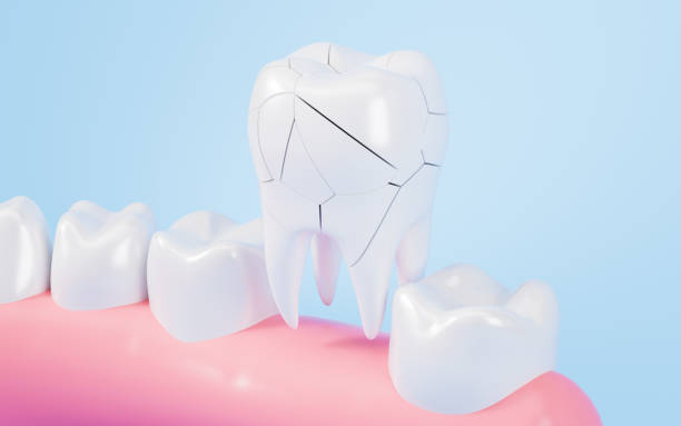 Immediate First Aid and Dental Care Guide Emergency Tooth Fracture Treatment in Pakistan: