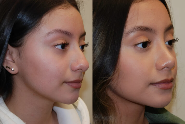rhinoplasty in islamabad