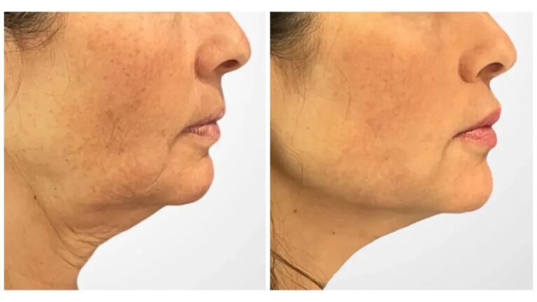 Best Doctors in Dubai Delivering Thread Lift Procedures with Minimal Downtime Recovery
